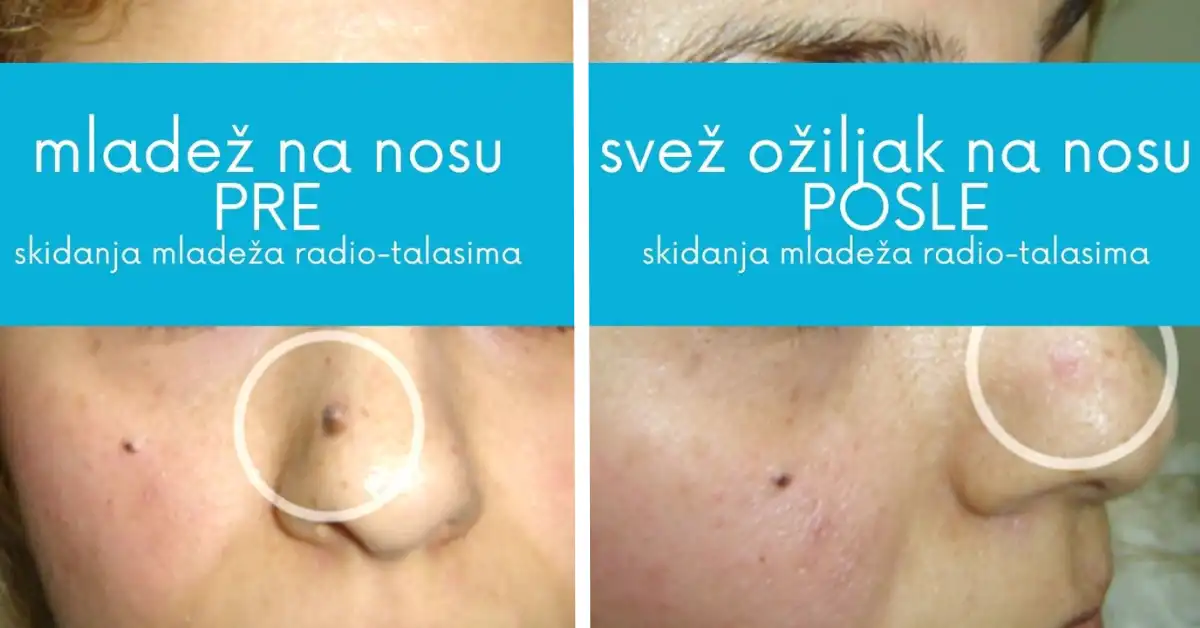 Radiotalasno uklanjanje mladeža rezultati pre i posle skidanja