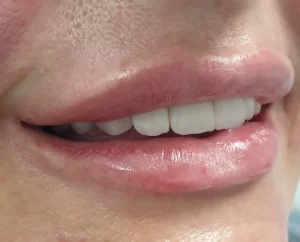 usne-hijaluron-poliklinika-diva