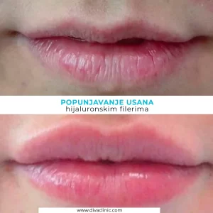 usne-nakon-procedure-hijaluronskim-filerima-poliklinika-diva