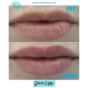 usne-pre-i-posle-procedure-sa-hijaluronom-poliklinika-diva