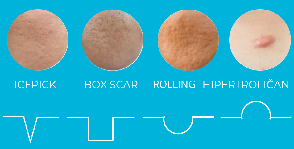 vrste-oziljaka-poliklinika-diva-dr-bogdanovic