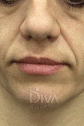 uklanjanje podocnjaka i nazolabijalnih bora hijaluronom PRE