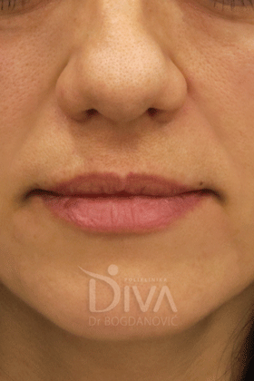 uklanjanje podocnjaka i nazolabijalnih bora hijaluronom POSLE
