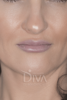 Povecanje usana hijaluronom PRE