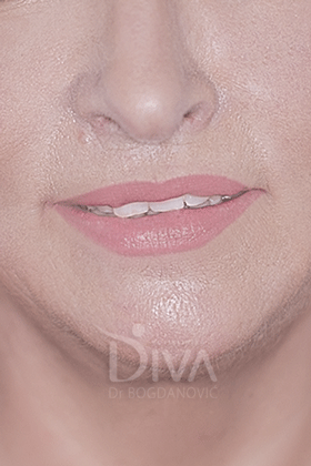 Podmlađivanje, korekcija bora i lifting laserom POSLE