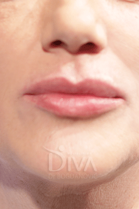 Usne Hijaluron POSLE Procedure