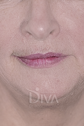 Podmlađivanje, korekcija bora i lifting laserom PRE