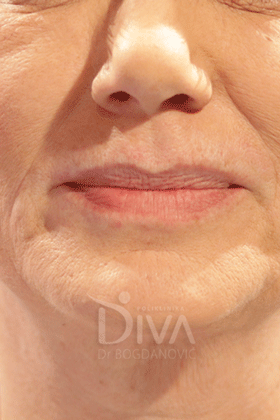 Usne Hijaluron PRE Procedure