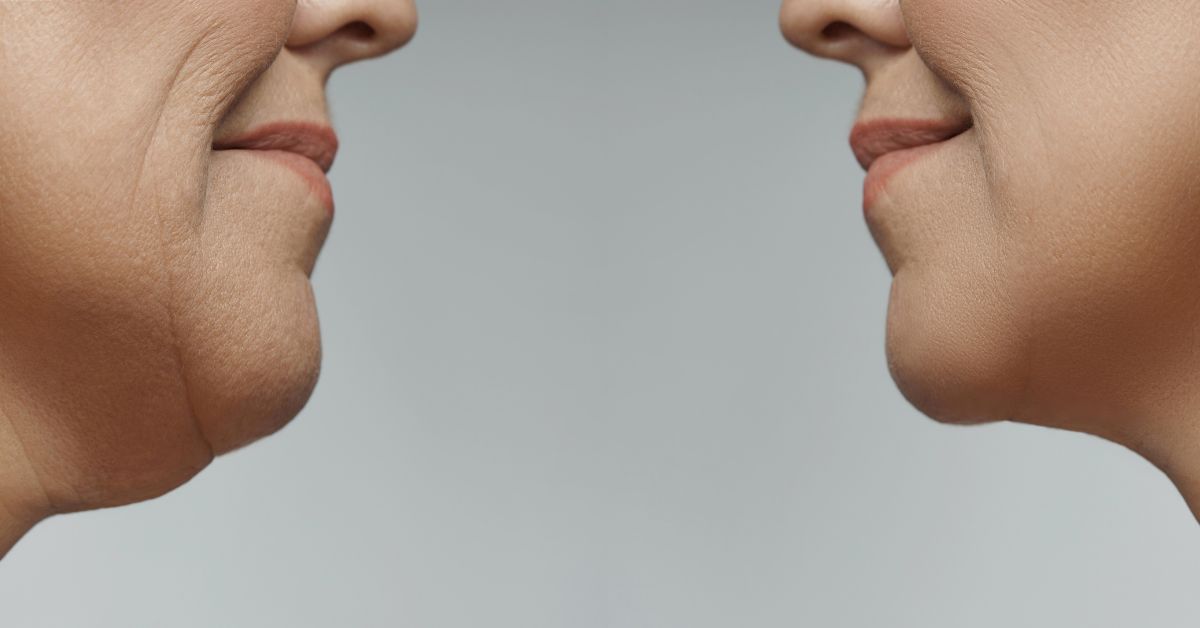 laserska-lipoliza-podbratka-poliklinika-diva