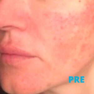 hiperpigmentacija-lica-poliklinika-diva-pre