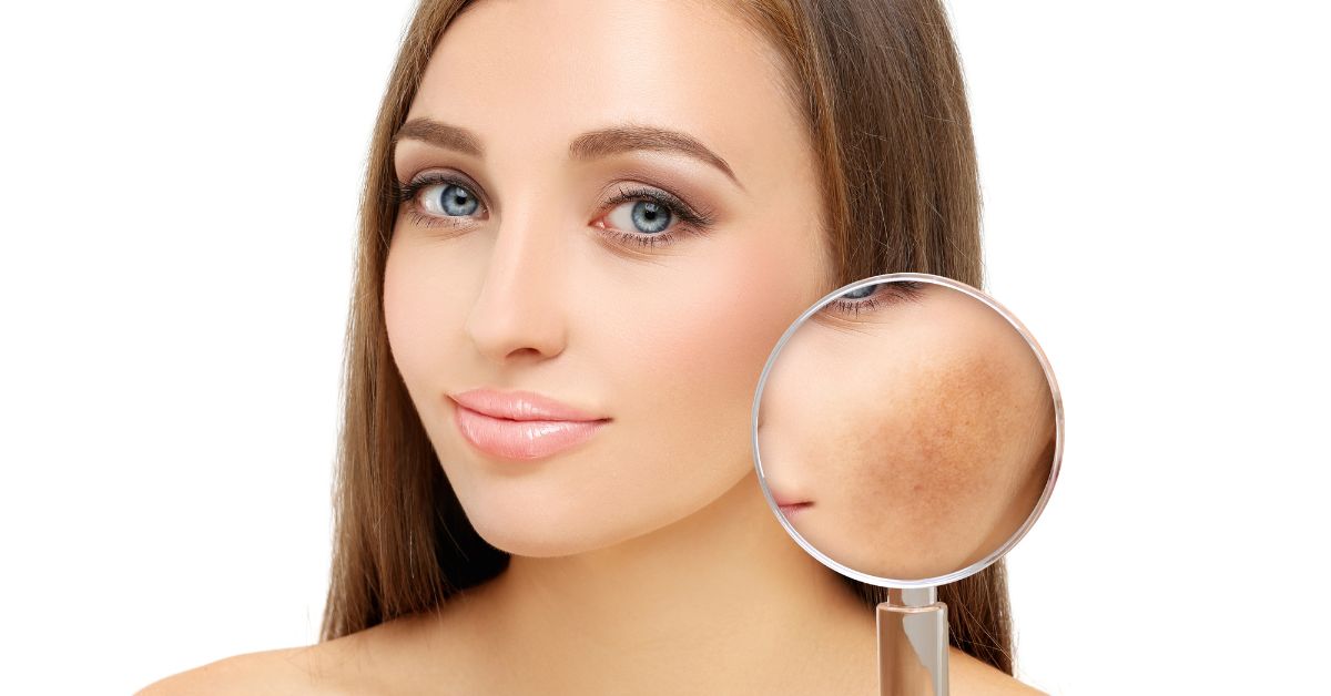 lasersko-uklanjanje-fleka-sa-lica-poliklinika-diva