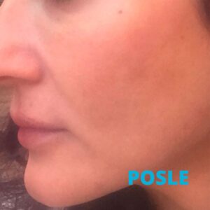 lasersko-uklanjanje-fleka-salica-iskustva-poliklinika-diva-posle