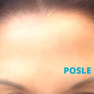 uklanjanje-fleka-na-kozi-laserom-posle-poliklinika-diva