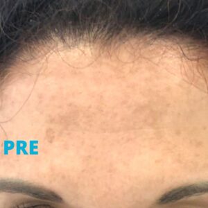 uklanjanje-fleka-na-kozi-laserom-pre-poliklinika-diva