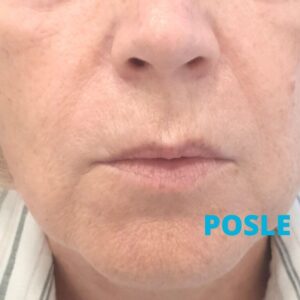 skinbooster-podmladjivanje-koze-poliklinika-diva-posle