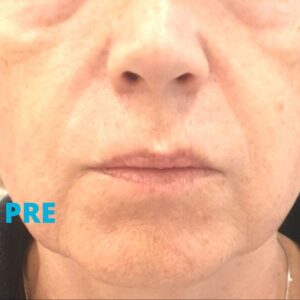 skinbooster-podmladjivanje-koze-poliklinika-diva-pre