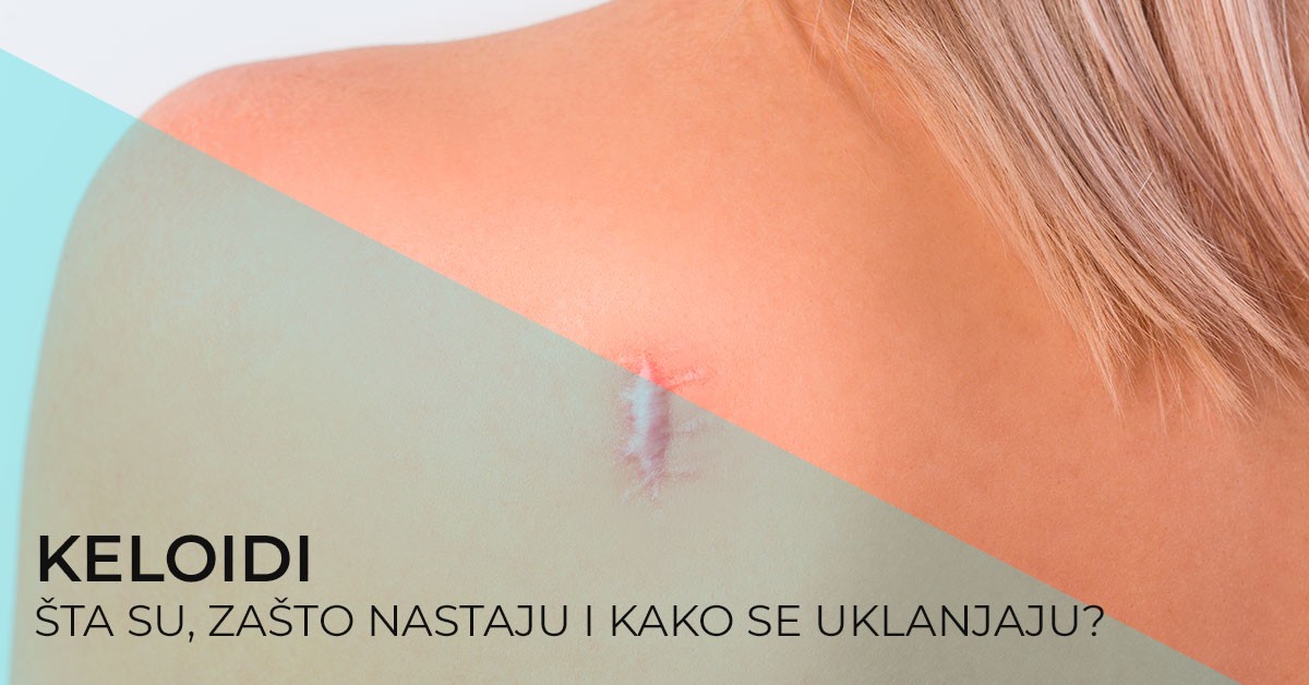 keloidni-oziljci-keloidi-sta-su-zasto-nastaju-i-kako-se-uklanjaju-poliklinika-diva-dr-bogdanovic-beograd