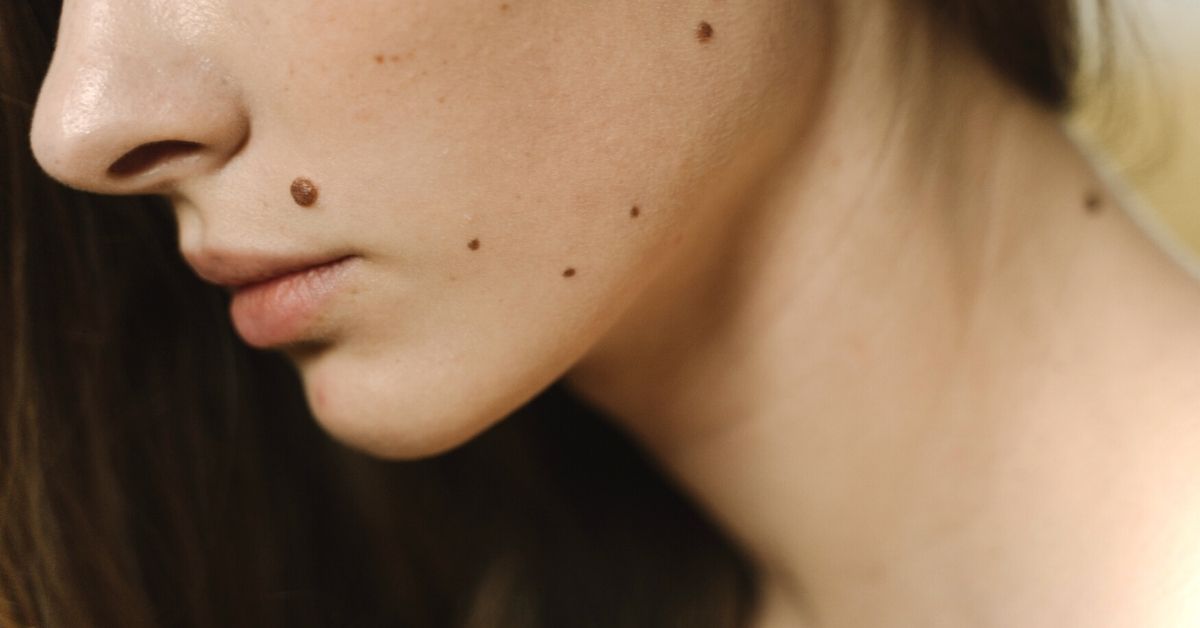 uklanjanje-mladeza-sa-lica-iz-estetskih-razloga-poliklinika-diva-dr-bogdanovic