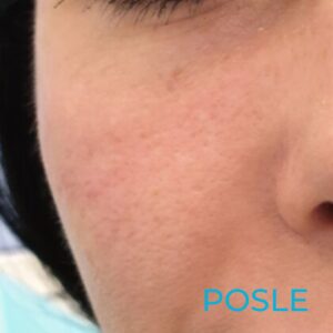 posle-topljenja-hijalurona-u-podočnjacima-poliklinika-diva