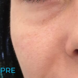 pre-topljenja-hijalurona-u-podočnjacima-poliklinika-diva