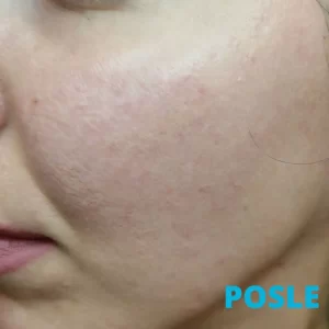 suzavanje-pora-laserom-posle-iskustva-tretman-za-pore-i-masnu-kozu-laserom-poliklinika-diva