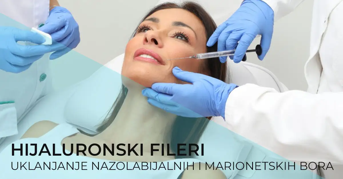 uklanjanje-nazolabijalnih-bora-hijaluronom-poliklinika-diva-dr-bogdanovic-marionetskih-bora-beograd