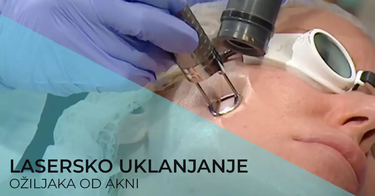 uklanjanje-oziljaka-od-akni-poliklinika-diva-dr-bogdanovic-beograd