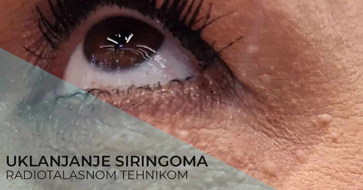Uklanjanje siringoma