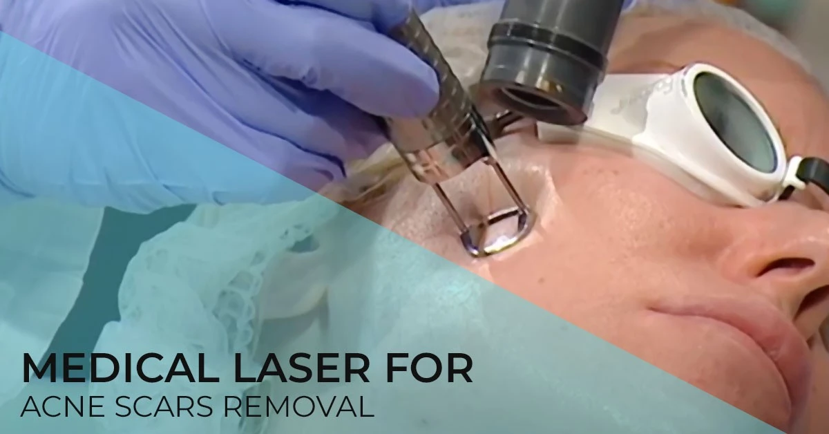 acne-scars-removal-diva-policlinic-dr-bogdanovic-belgrade